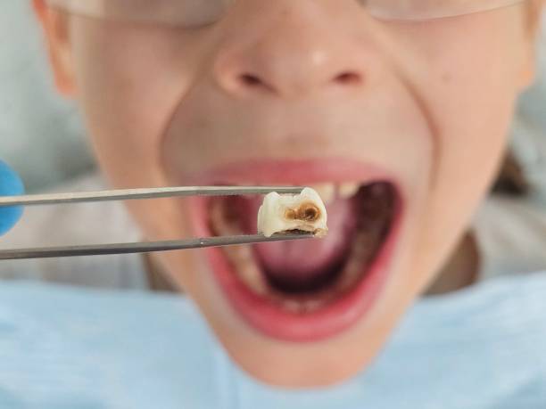 Best Emergency Broken Tooth Repair in Silsbee, TX
